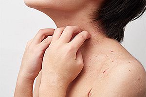 アトピー性皮膚炎の治療
